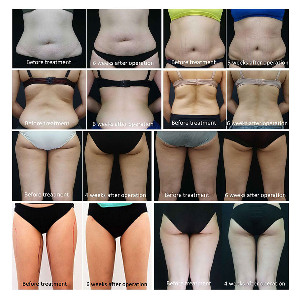 4 in 1 Body Contouring Machine with 360 Cryolipolysis Vacuum Sculpt RF 40K Cavitation Factory Direct