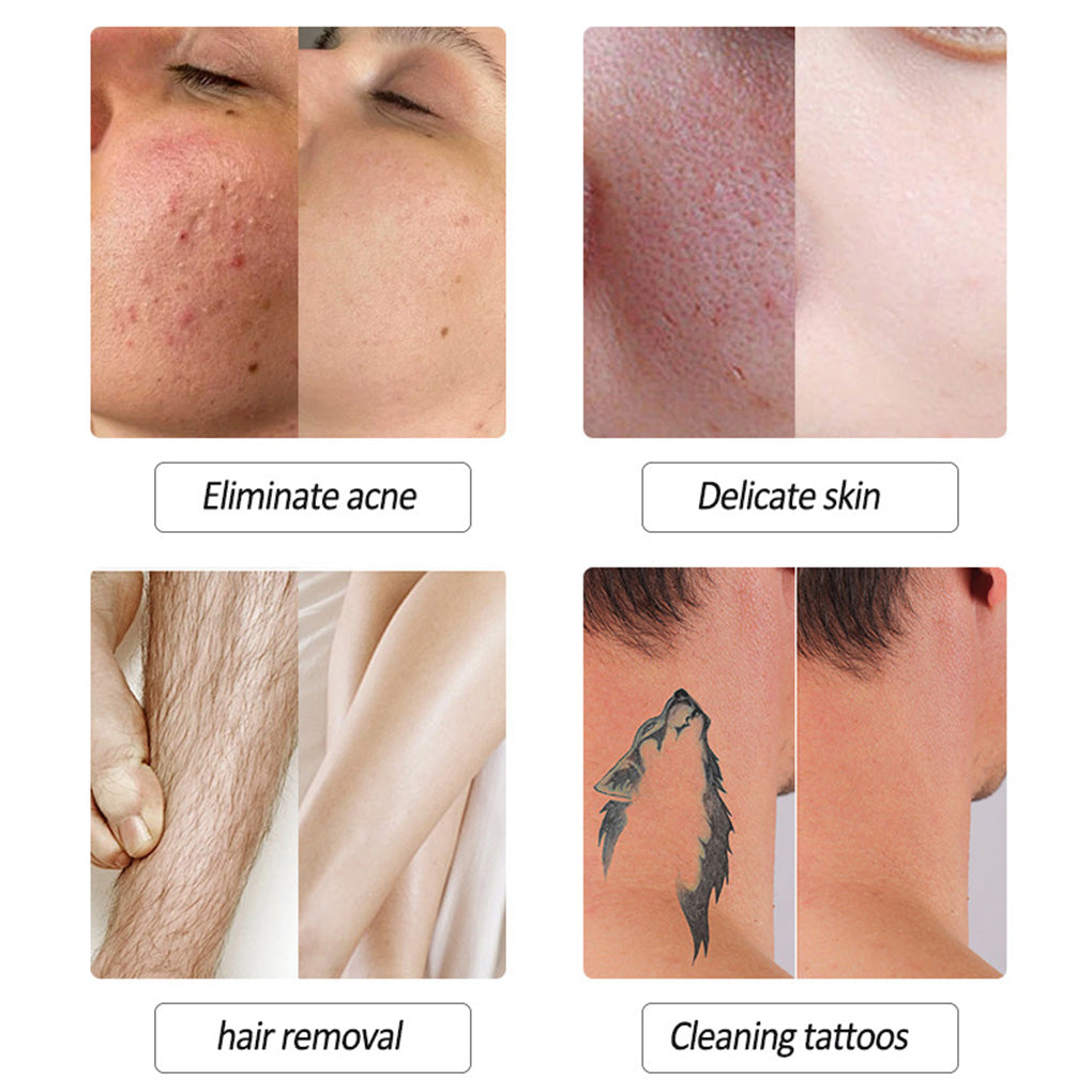 Professional Beauty Equipment 2-in-1 IPL & Q-Switch Laser Machine for Hair Removal and Tattoo Removal