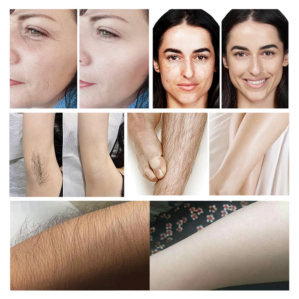 Multi-Function Diode Laser Hair Removal and Q-Switch Tattoo Removal Laser for Beauty Clinics