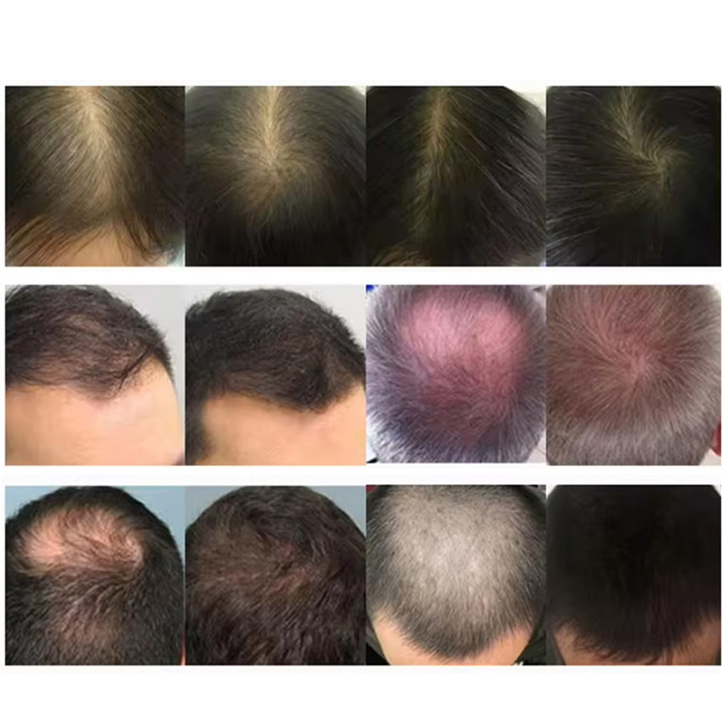 Multi-Functional Hair Loss Treatment Machine Beauty Salon Laser Therapy for Thinning Hair