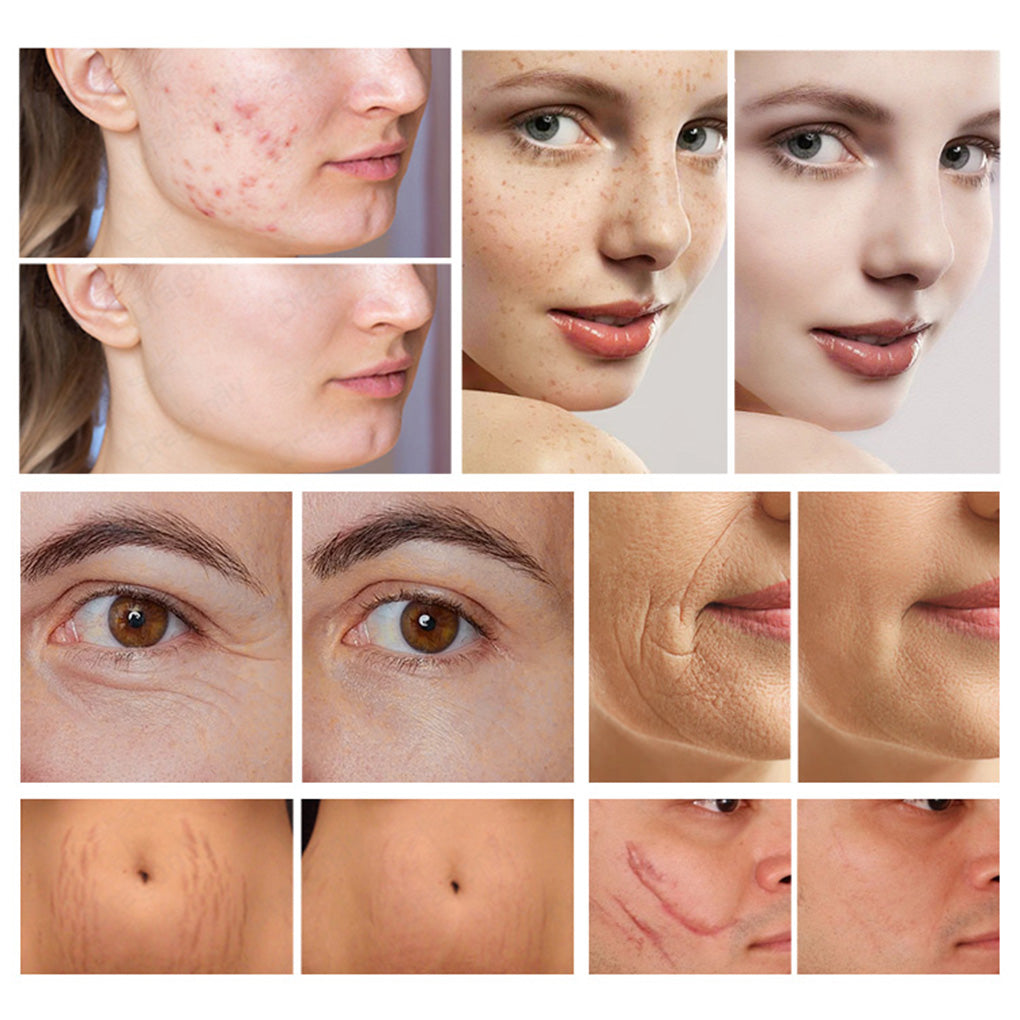 Fractional CO₂ Laser System for Multi Function Aesthetic Treatments Skin Rejuvenation and Pigmentation Correction