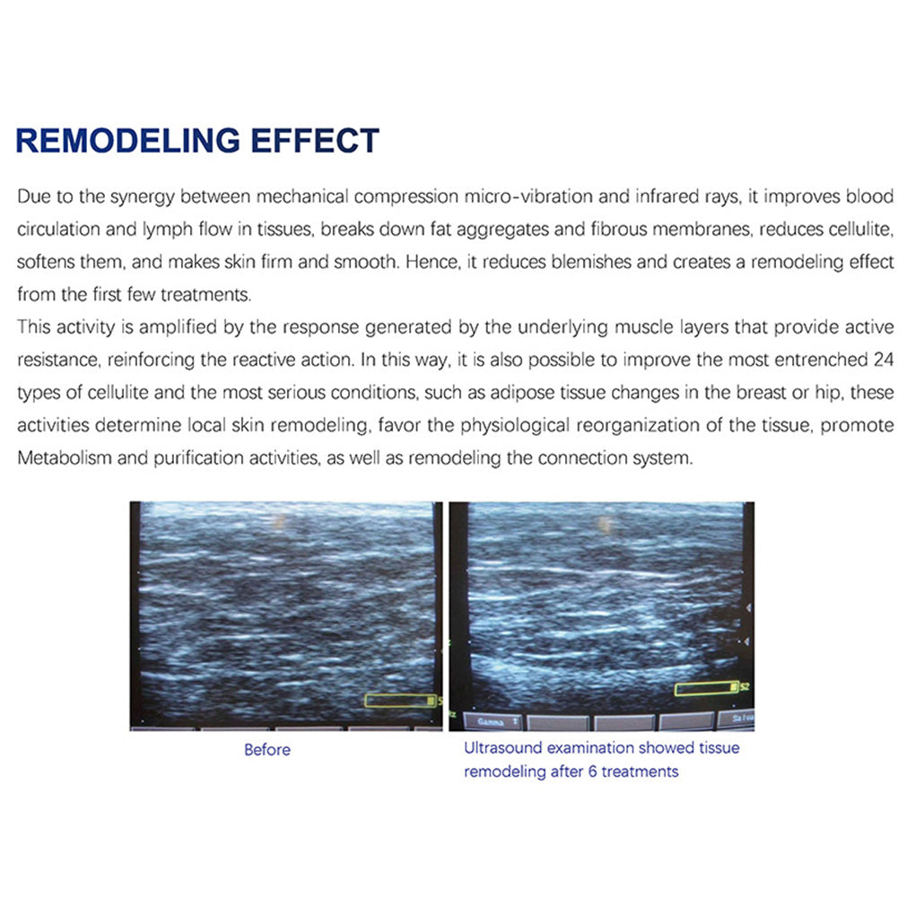 Professional Endosphere Roller Device for Cellulite Removal and Skin Tightening Manufacture Sales