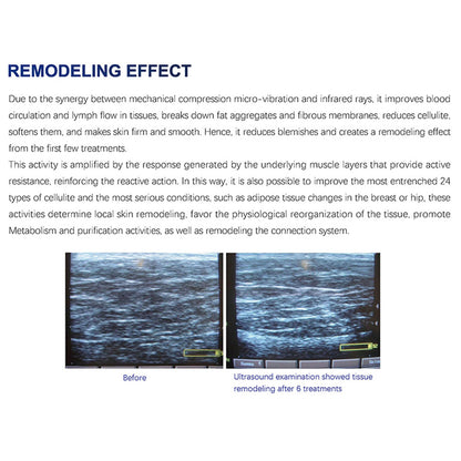 Professional Endosphere Roller Device for Cellulite Removal and Skin Tightening Manufacture Sales