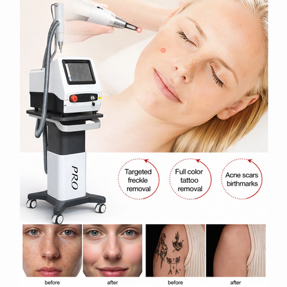 Advanced Tattoo Removal Machine Carbon Peeling Laser for Freckles, Birthmarks & Eyebrow Tattoo Fix