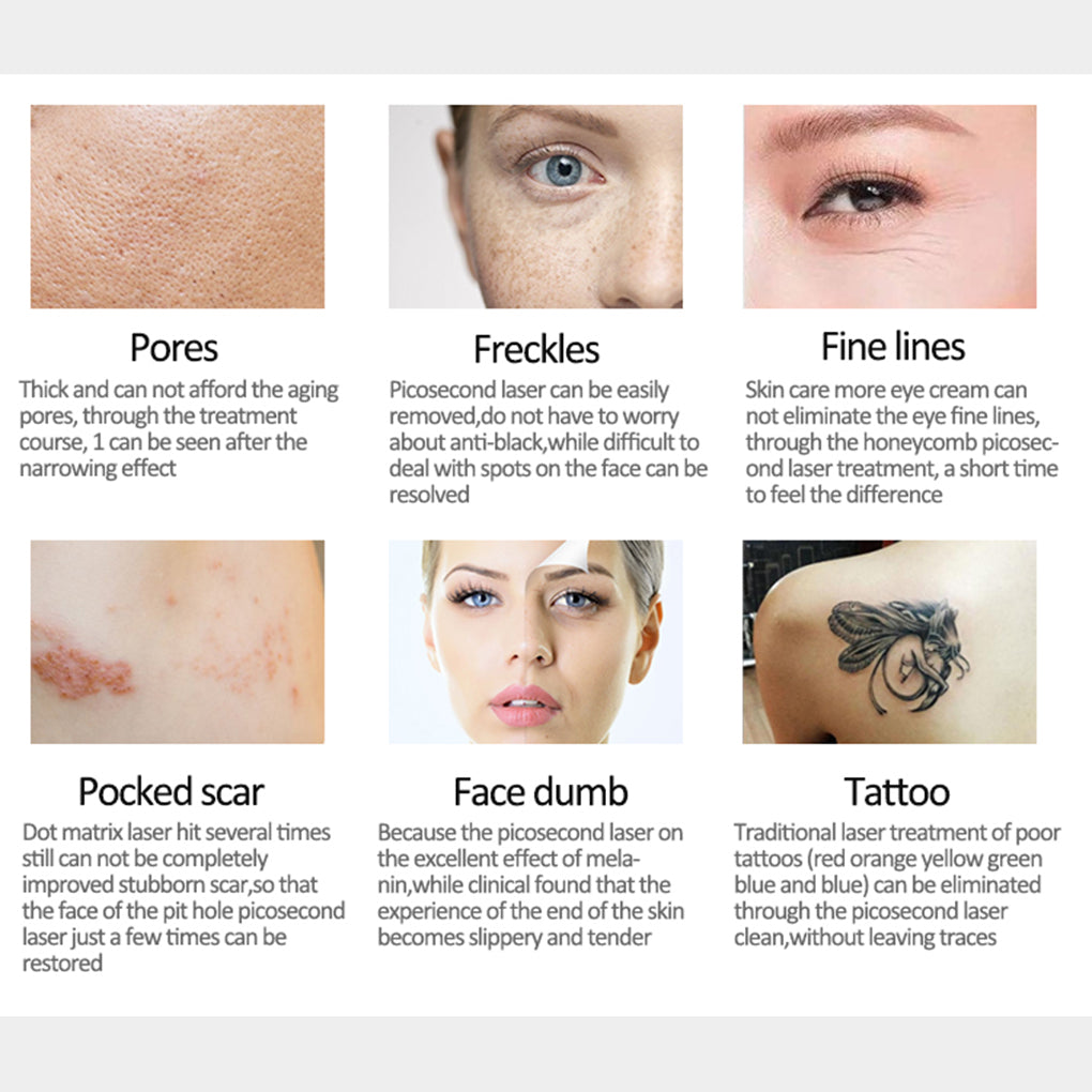 Professional Pigment Removal Laser Tattoo Age Spot & Carbon Peel Treatments Machine