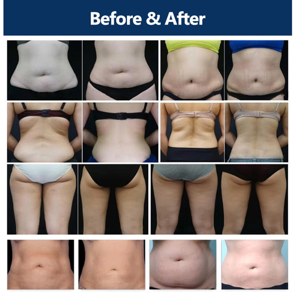 EMS Cryolipolysis Fat Freezing System for Body Shaping & Weight Loss Treatments