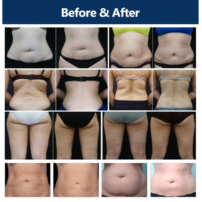 EMS Cryolipolysis Fat Freezing System for Body Shaping & Weight Loss Treatments