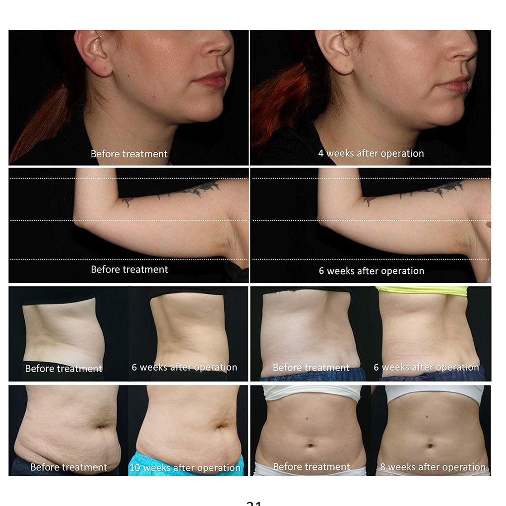 360 Fat Freeze Machine Cryolipolysis Smart Auto Recognition Applicators OEM Factory