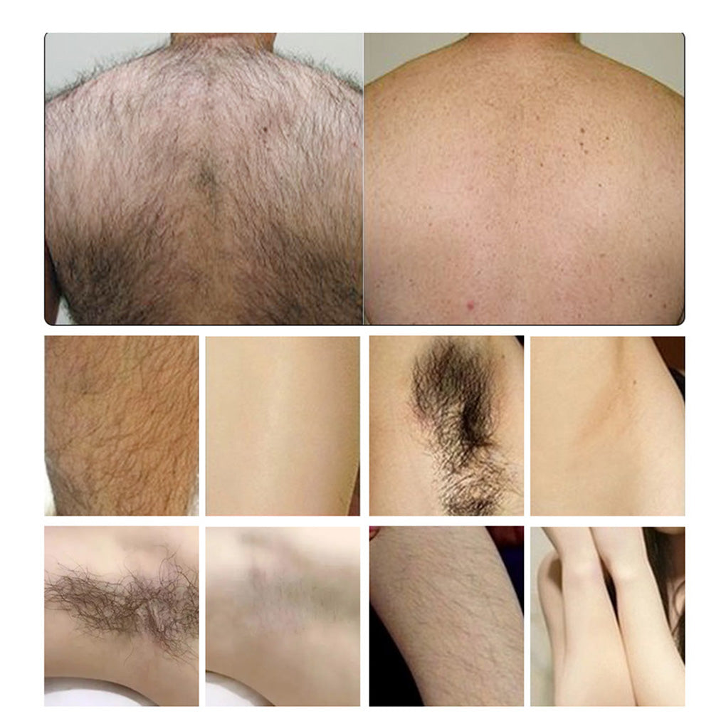 Professional Beauty Equipment 2-in-1 IPL & Q-Switch Laser Machine for Hair Removal and Tattoo Removal
