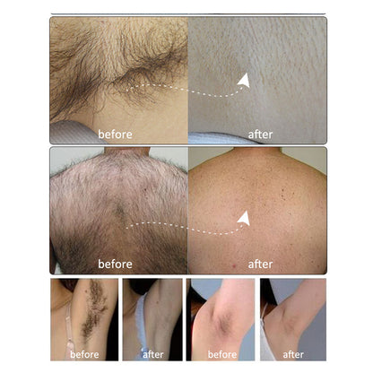 ND YAG Q Switched Laser Machine for Tattoo Removal Carbon Peeling Skin Brightening Treatment