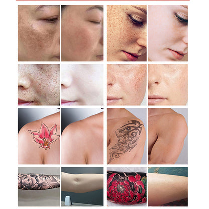 Advanced Tattoo Removal Machine Carbon Peeling Laser for Freckles, Birthmarks & Eyebrow Tattoo Fix