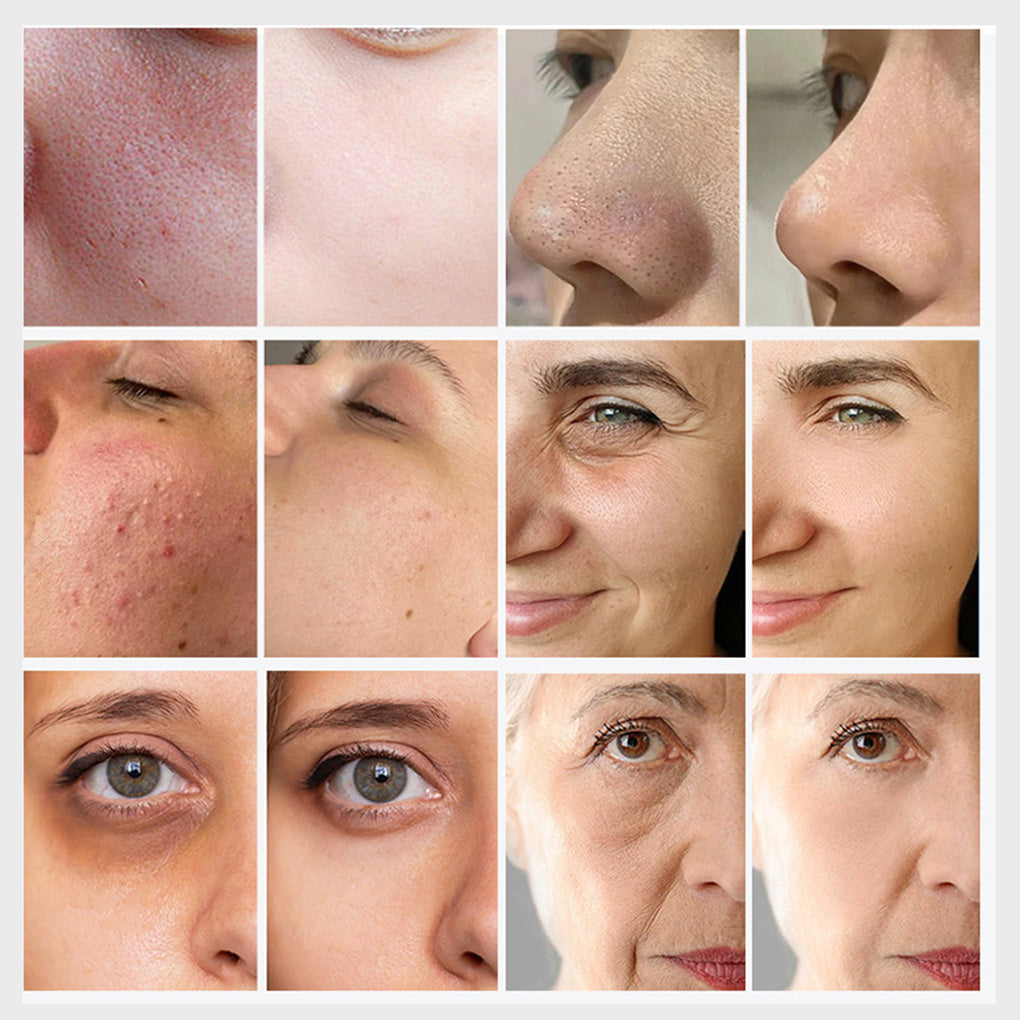 Factory Sale Deep Cleansing Facial Device Pore Extraction & Hydrating Skin Therapy