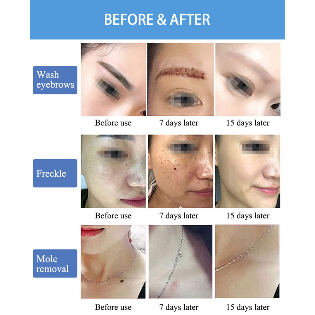 ND YAG Q Switched Laser Machine for Tattoo Removal Carbon Peeling Skin Brightening Treatment