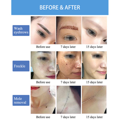 ND YAG Q Switched Laser Machine for Tattoo Removal Carbon Peeling Skin Brightening Treatment