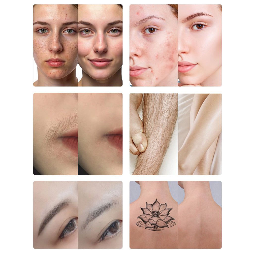 IPL Hair Removal & Q-Switch Laser Machine for Salons and Distributors