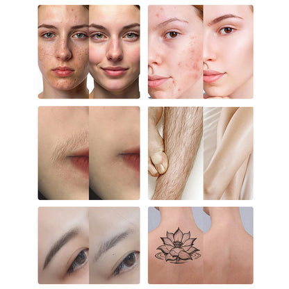 IPL Hair Removal & Q-Switch Laser Machine for Salons and Distributors