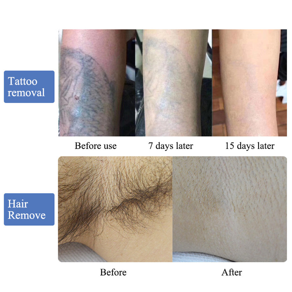 ND YAG Q Switched Laser Machine for Tattoo Removal Carbon Peeling Skin Brightening Treatment