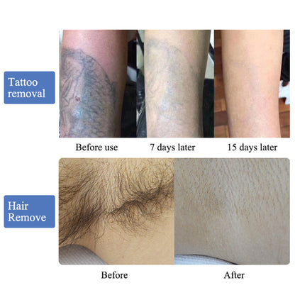 ND YAG Q Switched Laser Machine for Tattoo Removal Carbon Peeling Skin Brightening Treatment