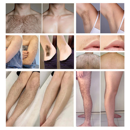 IPL Hair Removal & Q-Switch Laser Machine for Salons and Distributors