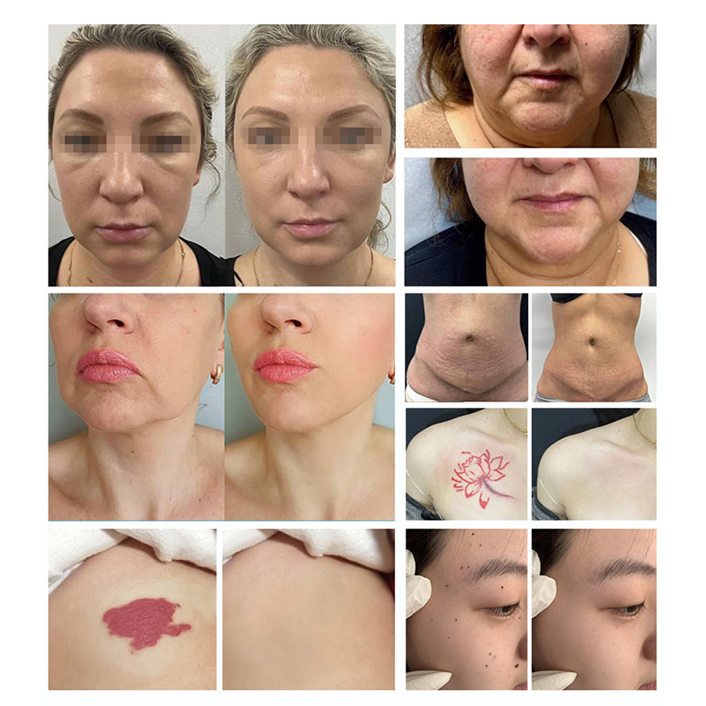 Carbon Peeling Laser Machine Q Switch ND YAG Tattoo Removal Pigmentation Removal Beauty Equipment