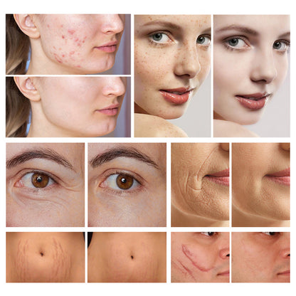 Fractional CO₂ Laser System for Multi Function Aesthetic Treatments Skin Rejuvenation and Pigmentation Correction