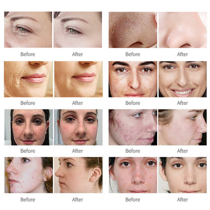 Professional Hydrodermabrasion Facial Machine Supplier Blackhead Removal & Hydration Treatment