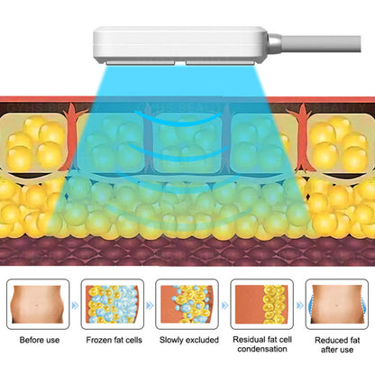 Cryolipolysis Fat Freezing Machine with EMS Body Sculpting for Slimming & Body Contouring