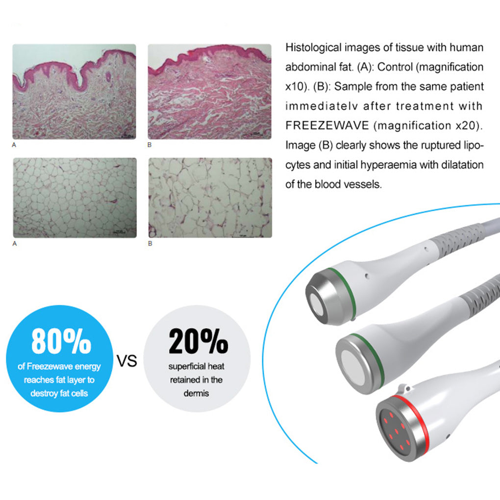 2.45GHz Coolwave Cellulite Treatment Machine Deep Fat Reduction Technology for Beauty Salon