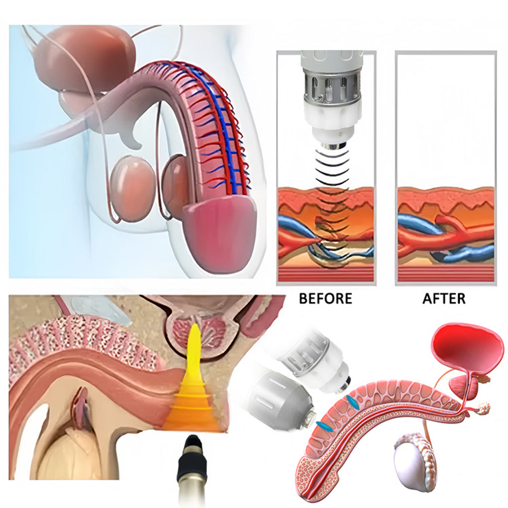 Wellness Clinic Portable Shockwave Therapy Machine for ED Fat Loss & Pain Release
