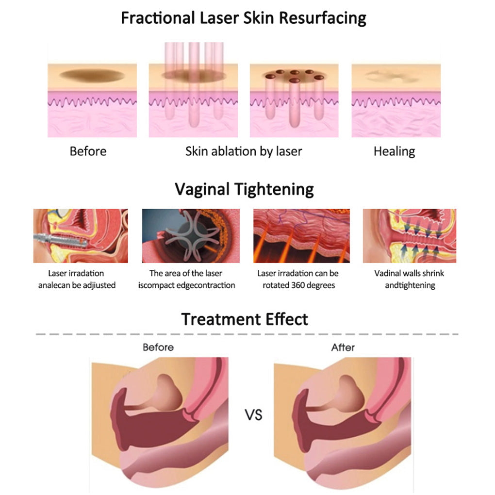 CO₂ Fractional Laser for Stretch Marks Scar Removal and Skin Resurfacing Clinics