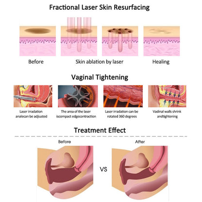 CO₂ Fractional Laser for Stretch Marks Scar Removal and Skin Resurfacing Clinics