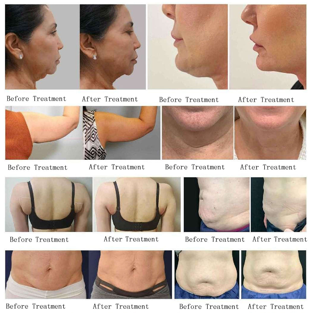 New Body Sculpt Machine RF Fat Reduction Beauty Machine for Double Chin Jawline and Face Tightening